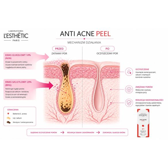 Anti Acne PEEL – Peeling Chemiczny do Skóry Trądzikowej 50ml