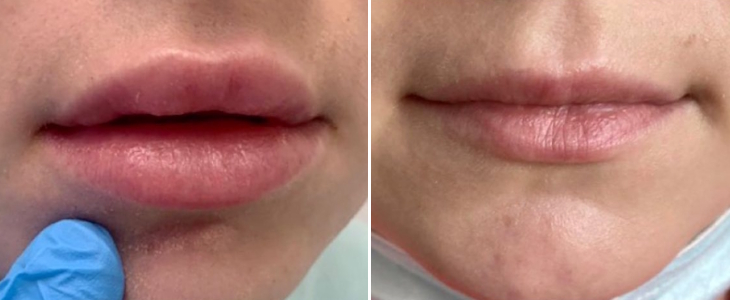 zabieg hialuronidazy