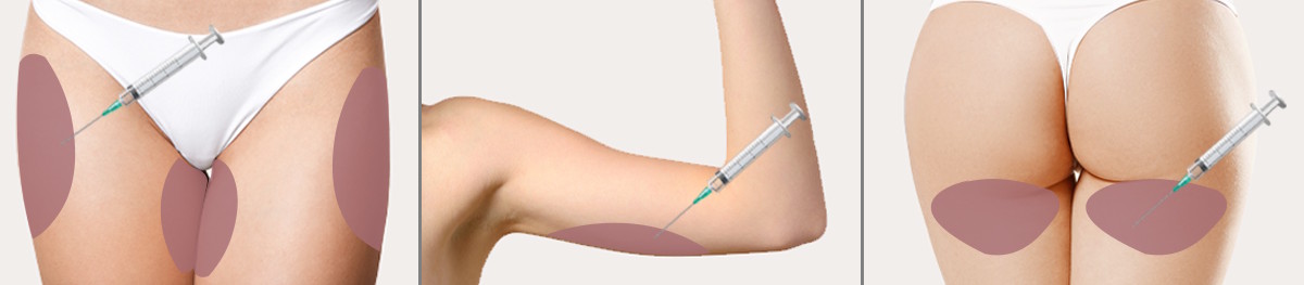  Obszary zastosowania Iniekcyjna lipoliza