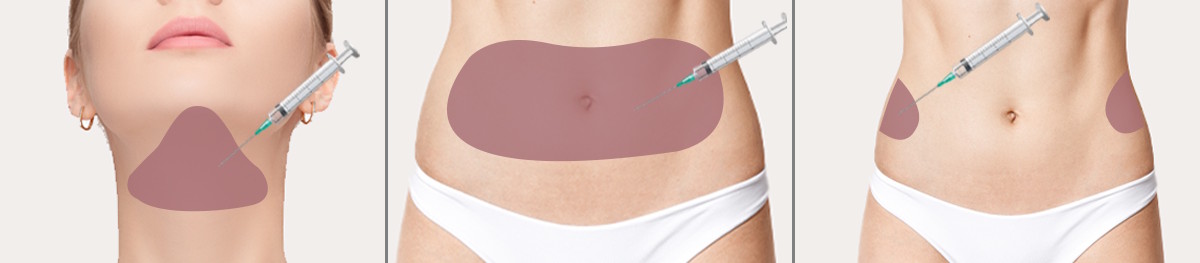 Iniekcyjna lipoliza Obszary zastosowania