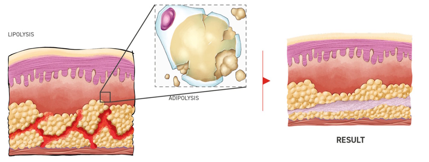 lipoliza edge solution