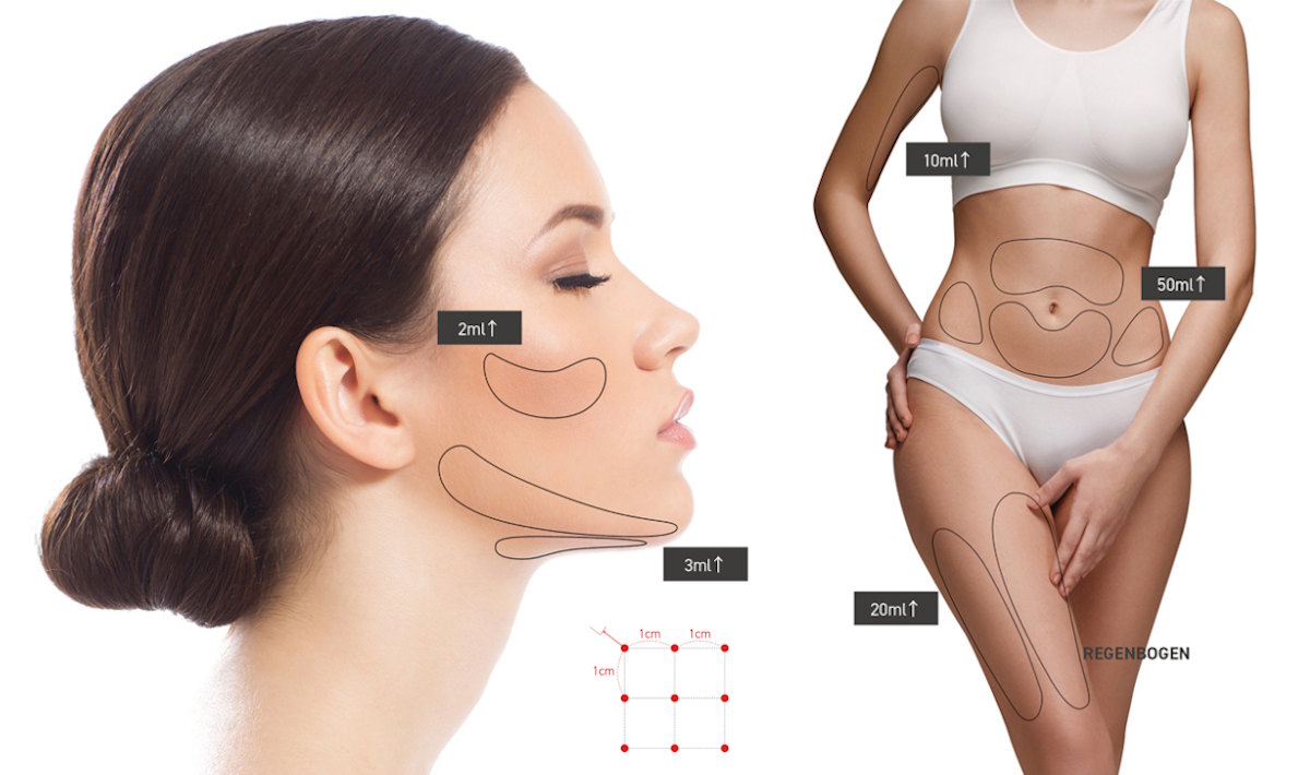 lipoliza edge solution zabieg