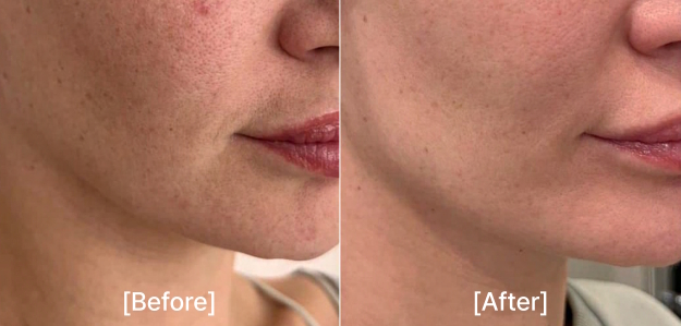 pollyfill before after