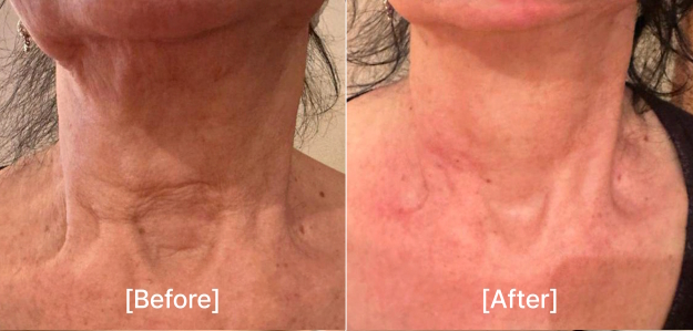 pollyfill before after1