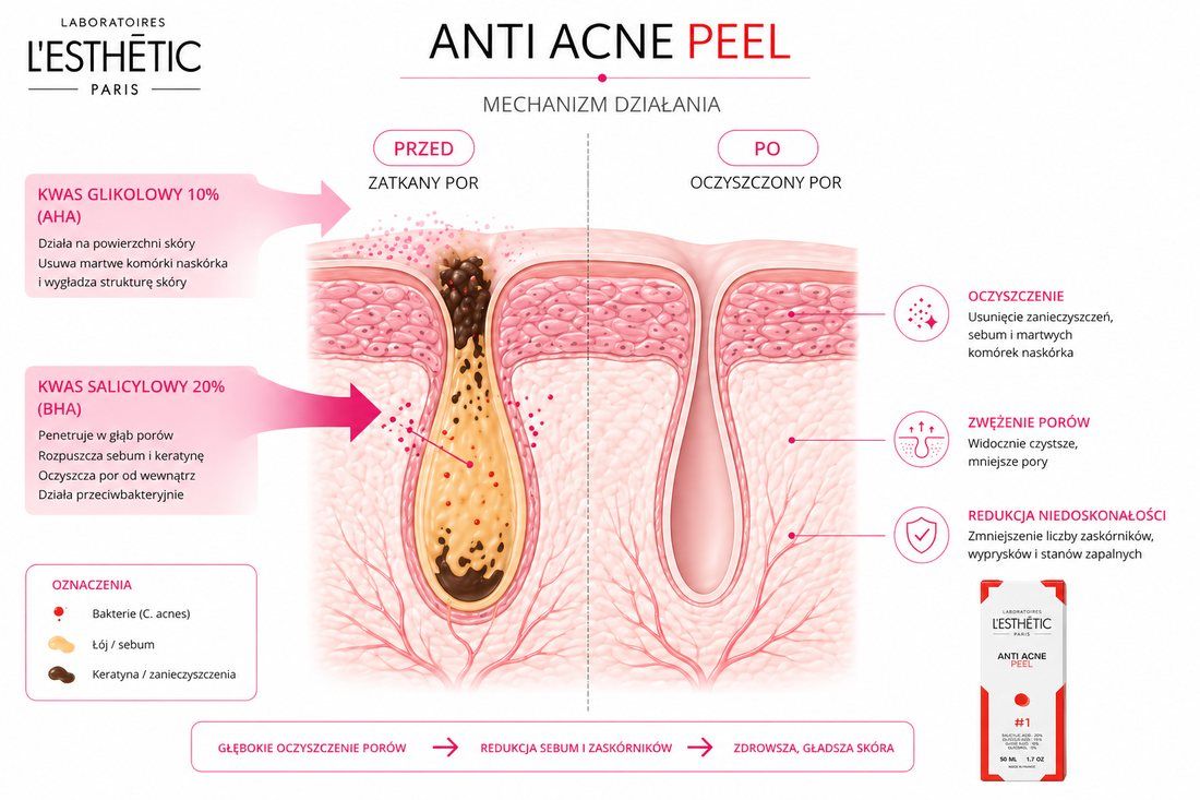 Anti Acne PEEL – mechanizm działania kwasu salicylowego w porze skóry
